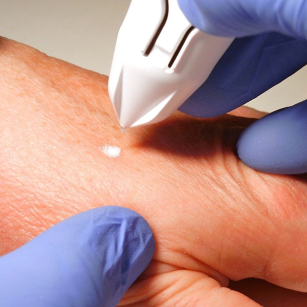 DISPOSITIVO CRIOCHIRURGICO CRYOCLEAR - cartuccia 16 g - usa e getta multiuso