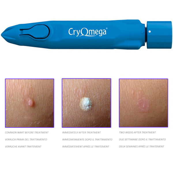DISPOSITIVO CRIOCHIRURGICO CRYOMEGA - cartuccia 16 g - usa e getta multiuso